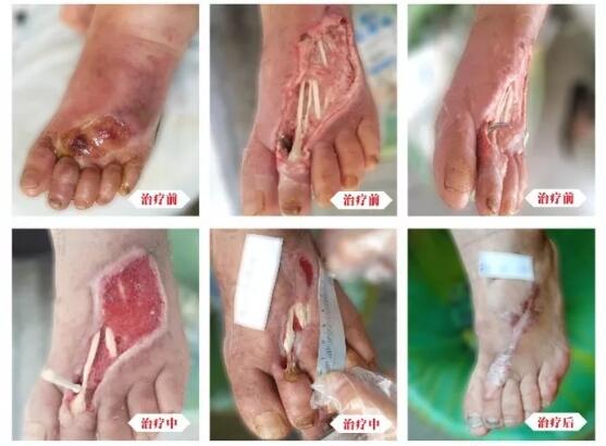 糖尿病并發(fā)癥有多可怕，及時(shí)治療糖尿病足避免截肢！
