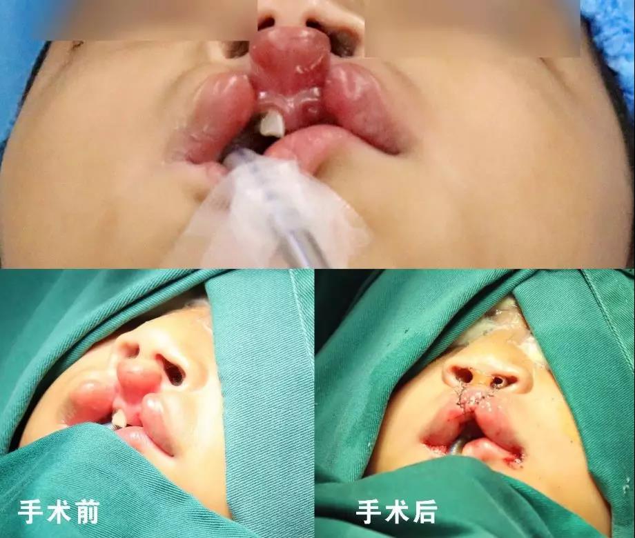 唇腭裂盡早治療消除孩子自卑心理，快樂成長！