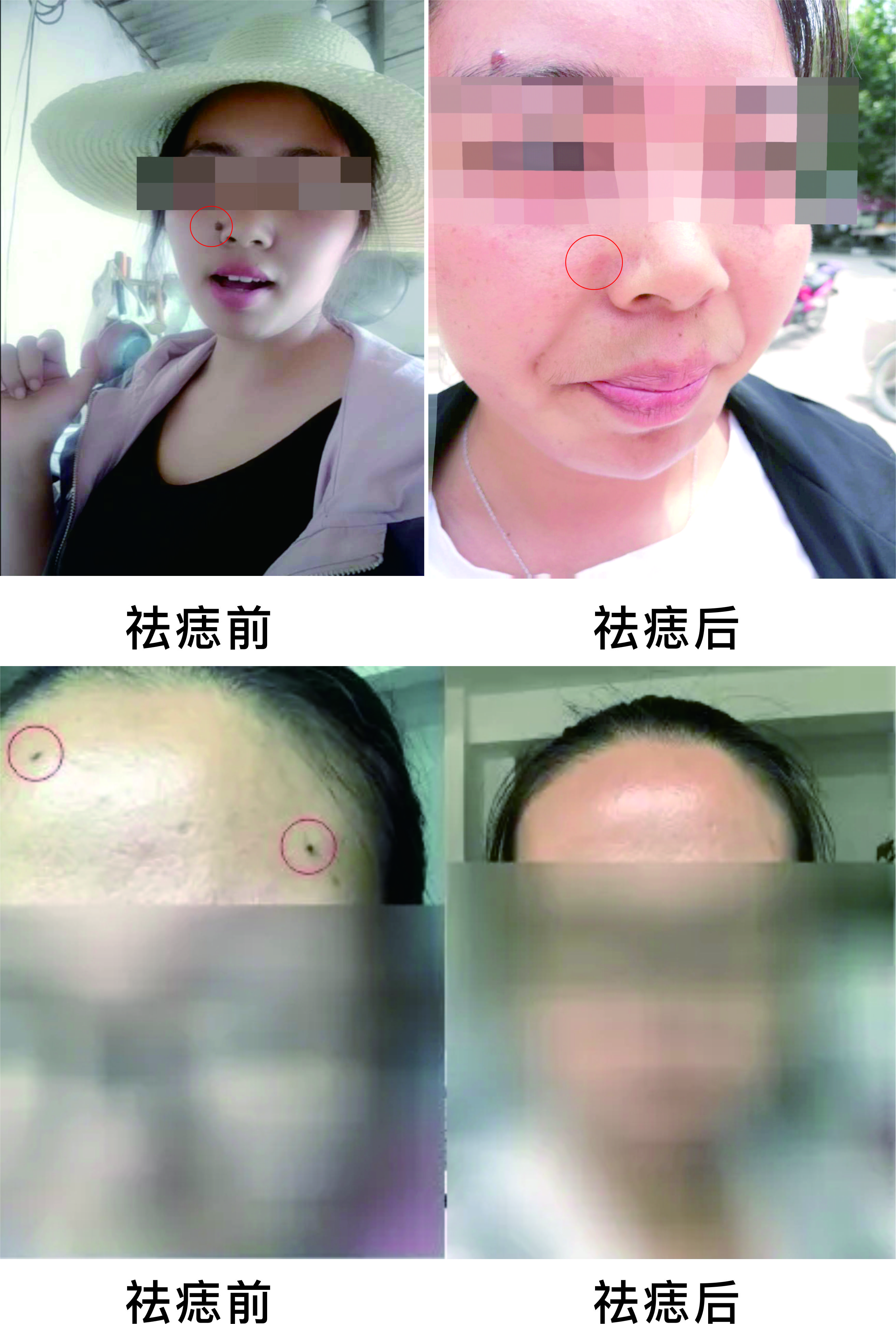 微波祛痣，告別臉部多余的“點(diǎn)綴”~