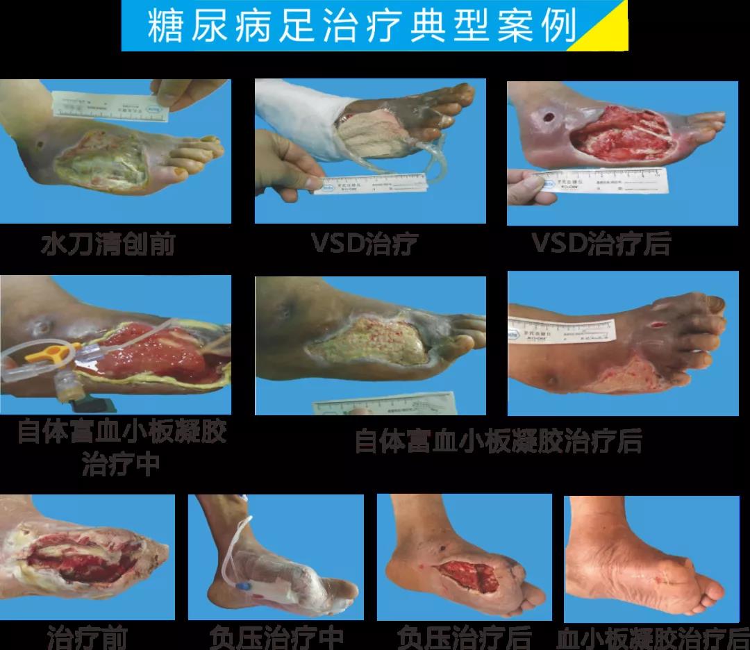 截肢、失明，甚至……，我們要做的是將糖尿病并發(fā)癥遏制在搖籃里！