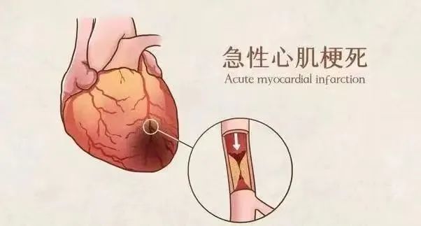 【保山安利醫(yī)院】11月20日“心梗救治日” 時(shí)間就是心肌，時(shí)間就是生命！